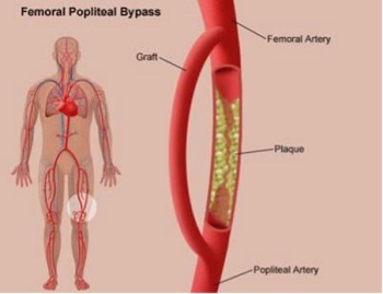 NGUYÊN NHÂN, TRIỆU CHỨNG, CÁCH PHÒNG BỆNH XƠ VỮA ĐỘNG MẠCH